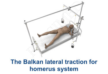 The Balkan lateral traction for homerus system