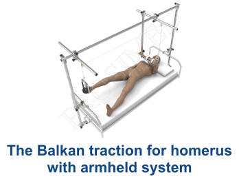 The Balkan traction for homerus with armheld system