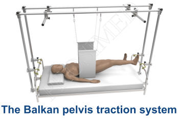 The Balkan pelvis traction system